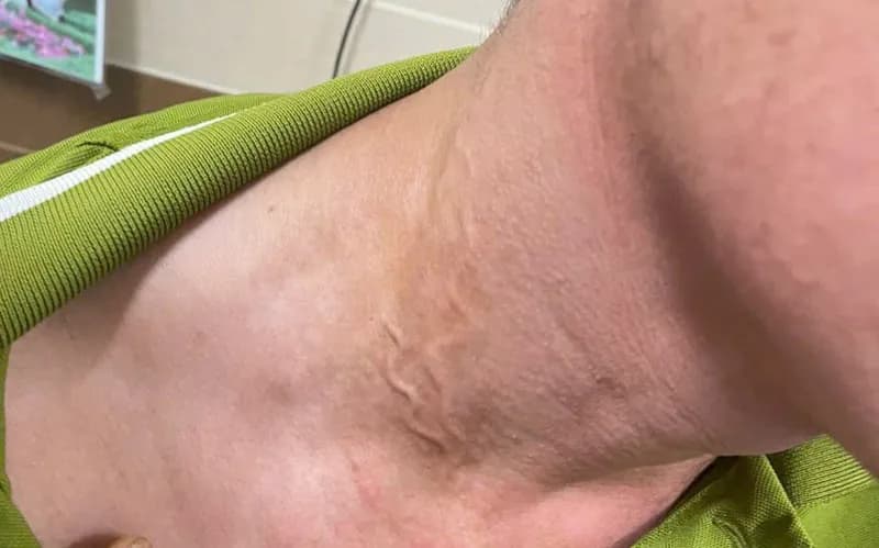 Phát hiện thêm ca bệnh giun rồng tại Phú Thọ