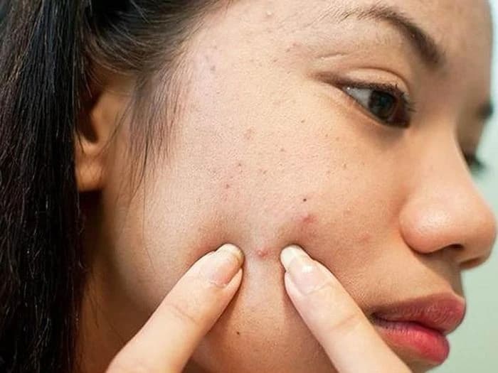 Giải pháp hạn chế tiết dầu cho da dầu vào mùa hè