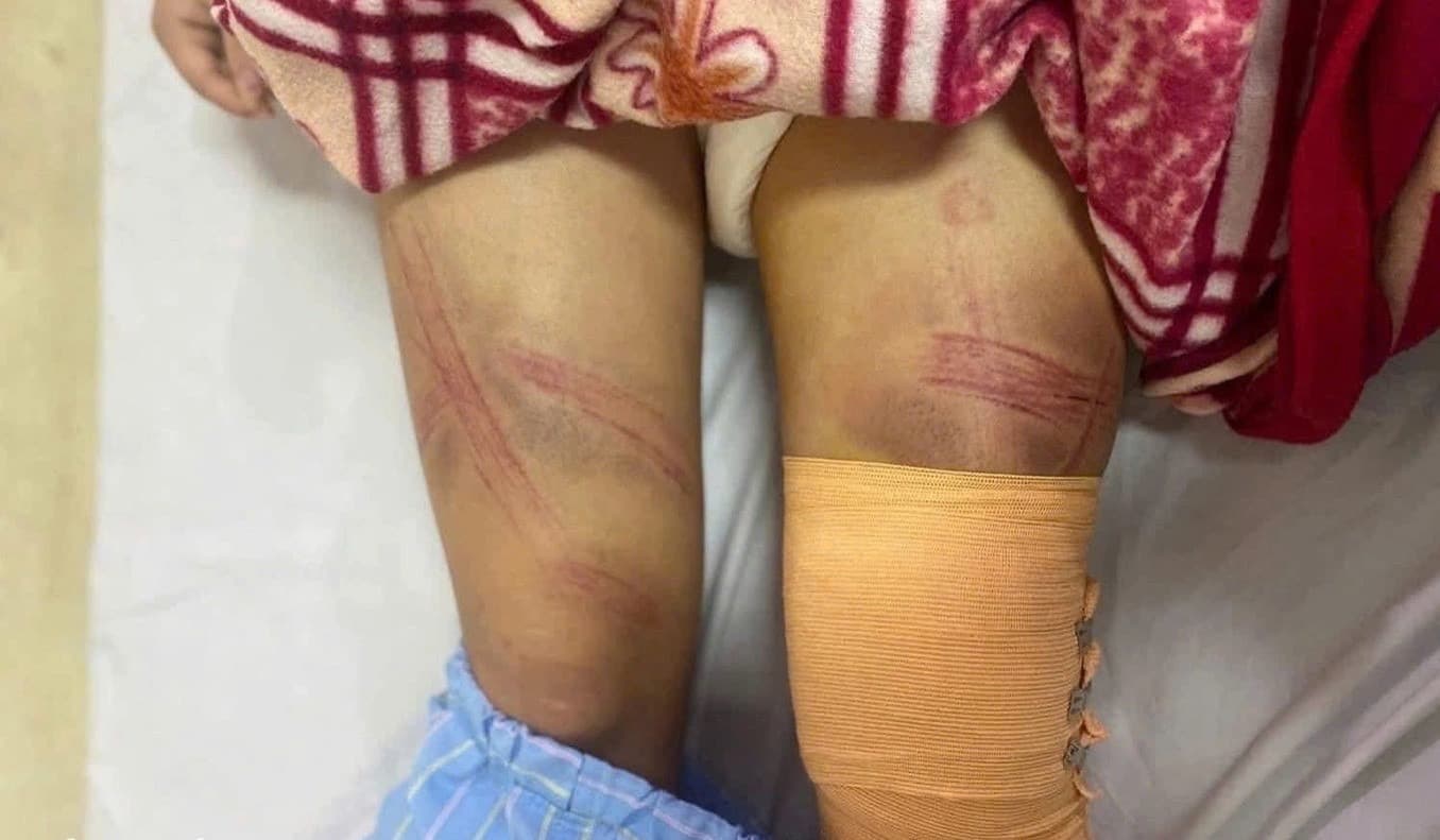 Vụ bé gái lớp 7 bị bố đánh nhập viện ở Nghệ An: Nguồn cơn từ con lợn đất?