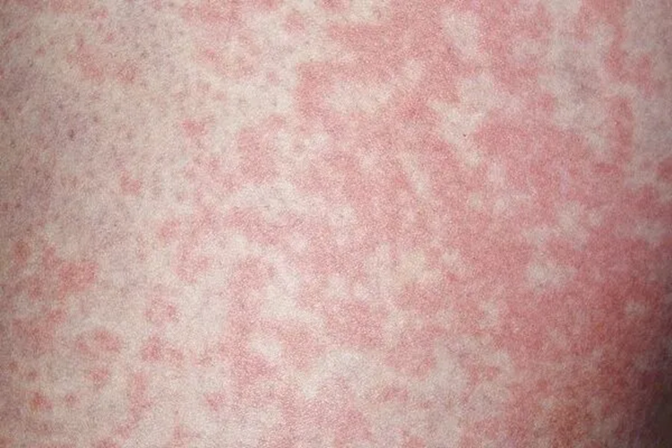 Người đàn ông nhiễm nấm vùng kín vì thói quen nhiều người làm với đồ lót của mình