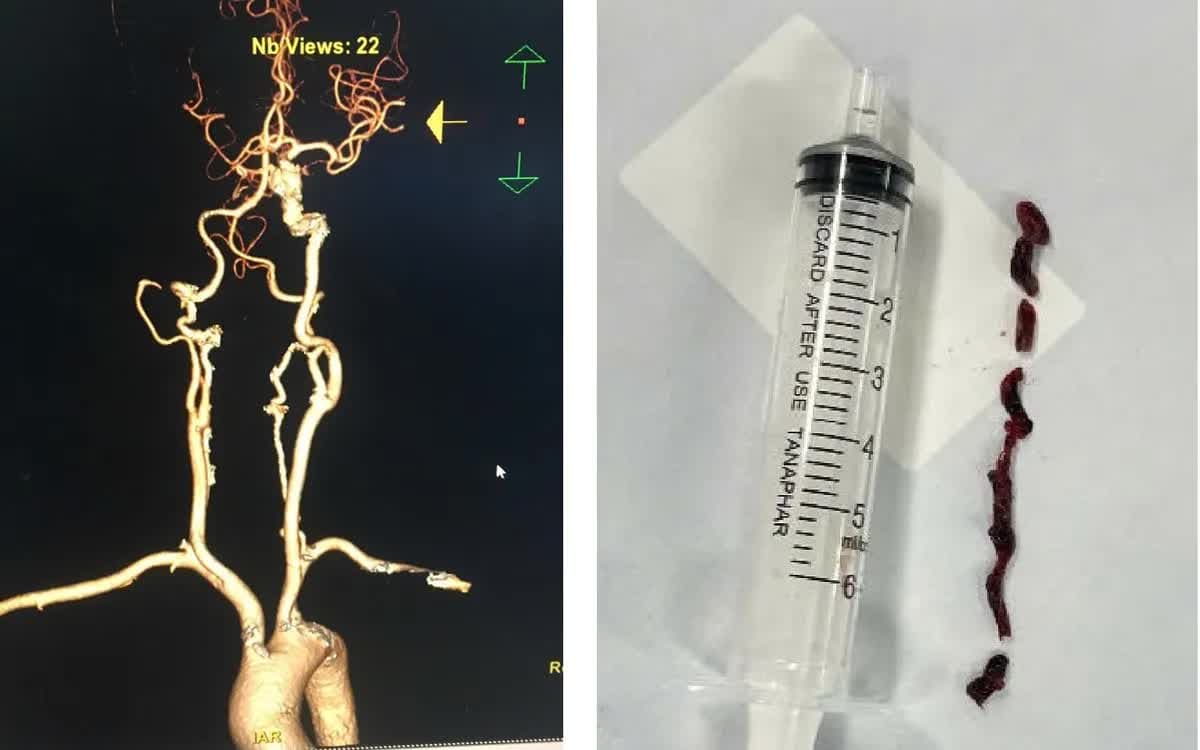 Cấp cứu đột quỵ kịp thời, phối hợp liên tuyến cứu bệnh nhân 75 tuổi