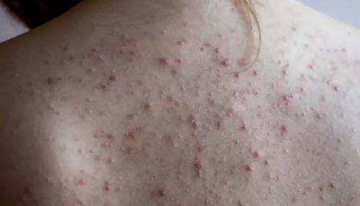 Top 10 Sản Phẩm Trị Mụn Lưng Tốt Nhất: Hiệu Quả Cao & An Toàn Cho Da