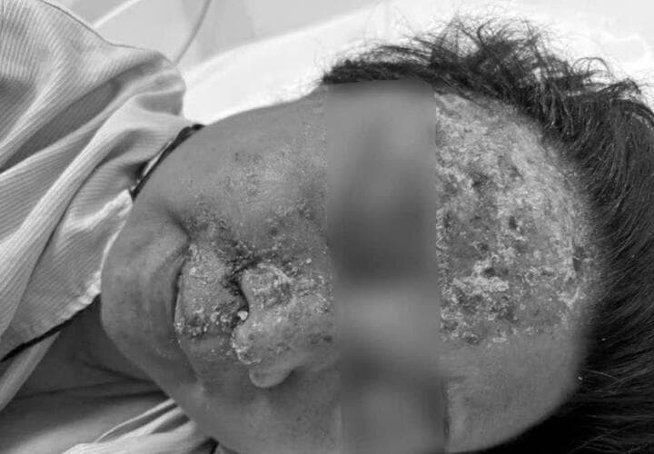 Nổi mụn nước tưởng dị ứng da, không ngờ nhiễm virus gây biến chứng nguy hiểm