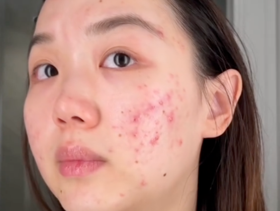 “Gái Đẹp” Hàn Quốc Chia Sẻ Bí Quyết Cứu Làn Da Mụn “Như Cơm Cháy” Đơn Giản Tại Nhà