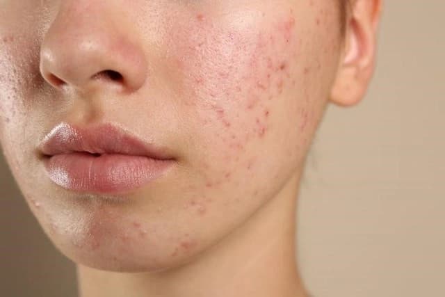 Kháng kháng sinh trong điều trị mụn và giải pháp thay thế từ tia Plasma lạnh